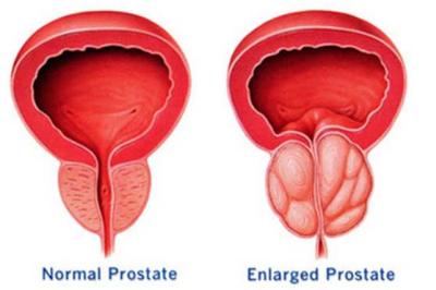 Recurso natural para cuidar y prevenir enfermedades de la próstata